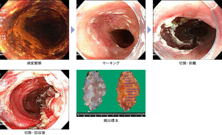内視鏡的粘膜切除、粘膜下層剥離術（ESD）イメージ画像