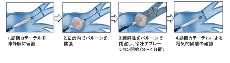 冷凍アブレーション（クライオアブレーション）