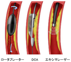 図4 各種アテレクトミーデバイス