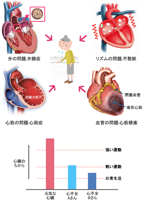 浅大腿動脈用ステントグラフト