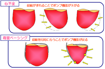 両心室ペーシング機能付き植え込み型除細動器