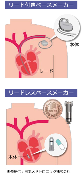 リードレスペースメーカー