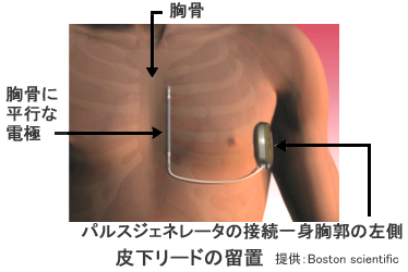 皮下植え込み型除細動器