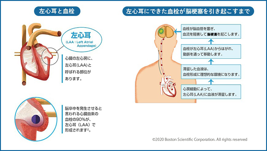 左心耳と血栓