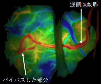 直接バイパス後