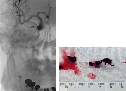 （左）内頸動脈は再開通し、症状は改善した（右）ステントレトリーバーで回収された血栓