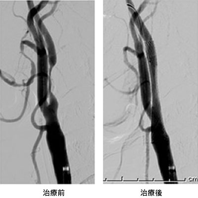 （写真左）治療前　（写真右）治療後