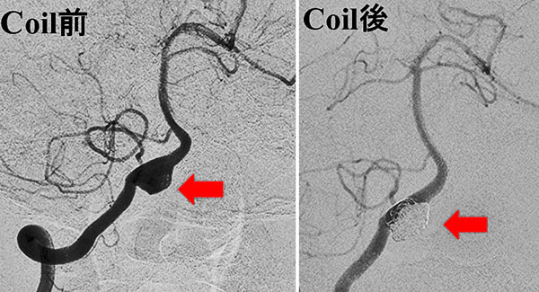 脳動脈瘤コイル塞栓術（ステントアシストテクニック）