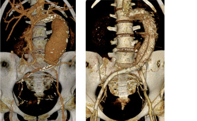 右外腸骨動脈閉塞を合併した腹部大動脈瘤に対するステントグラフト留置術前後