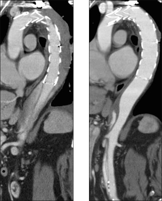 （左）術後1週間、胸部解離腔はすでに血栓化<br>（右）術後4ヶ月、胸部解離腔は消退し、真腔も拡大