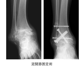 変形性足関節症02