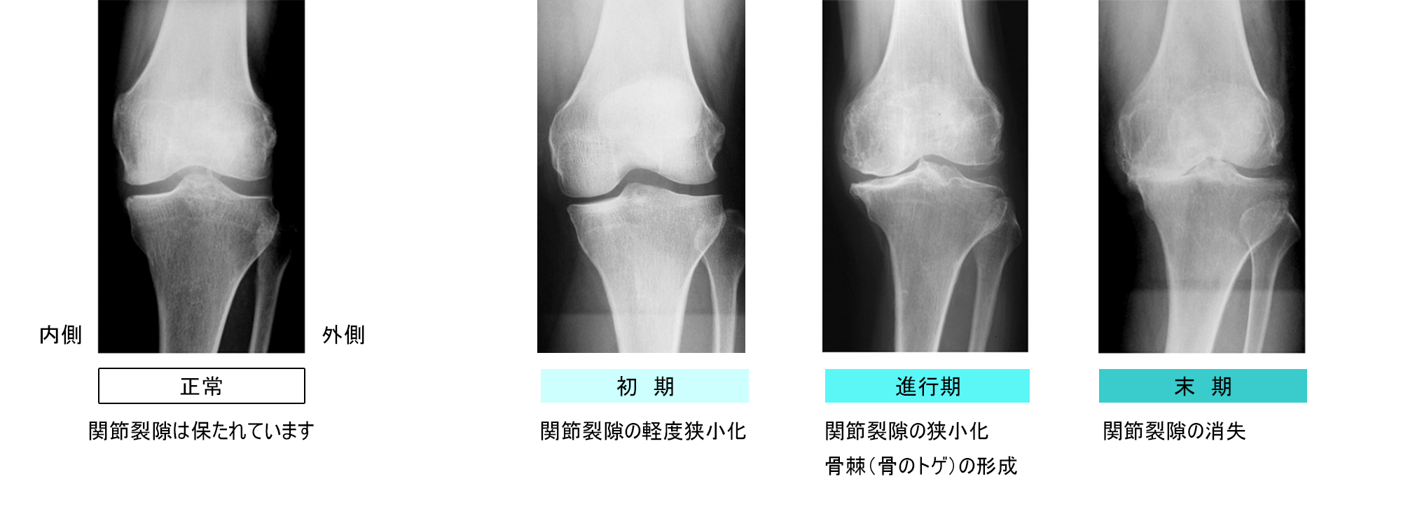 変形性膝関節症