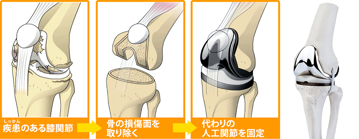 低価再入荷 人工肢膝関節ロック人工膝関節付き単軸膝関節