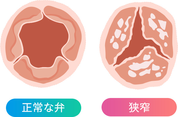 画像：正常な弁と狭窄