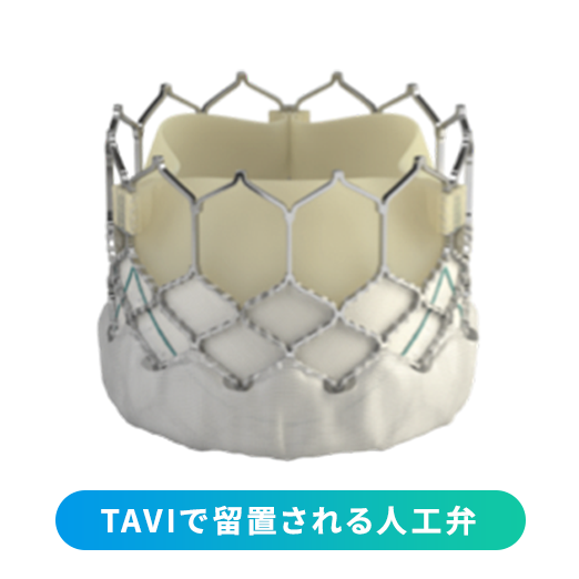 画像：TAVIで留置される人工弁