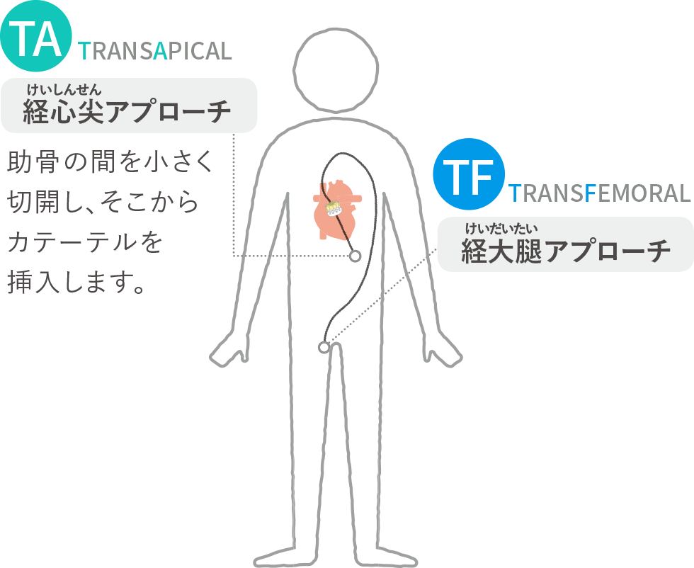 「TA（TRANSAPICAL）」経心尖（けいしんせん）アプローチ。助骨の間を小さく切開し、そこからカテーテルを挿入します。「TF（TRANSFEMORAL）」経大腿（けいだいたい）アプローチ。