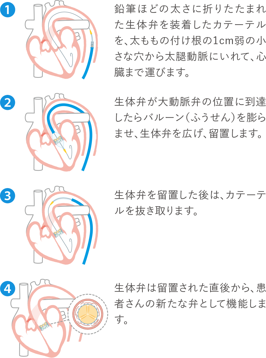 （1）鉛筆ほどの太さに折りたたまれた生体弁を装着したカテーテルを、太ももの付け根の1cm弱の小さな穴から太腿動脈にいれて、心臓まで運びます。（2）生体弁が大動脈弁の位置に到達したらバルーン（ふうせん）を膨らませ、生体弁を広げ、留置します。（3）生体弁を留置した後は、カテーテルを抜き取ります。（4）生体弁は留置された直後から、患者さんの新たな弁として機能します。