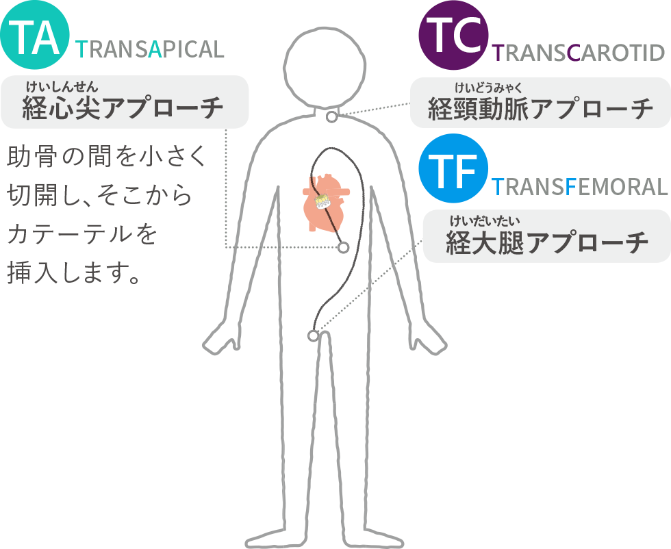 「TA（TRANSAPICAL）」経心尖（けいしんせん）アプローチ。助骨の間を小さく切開し、そこからカテーテルを挿入します。「TF（TRANSFEMORAL）」経大腿（けいだいたい）アプローチ。